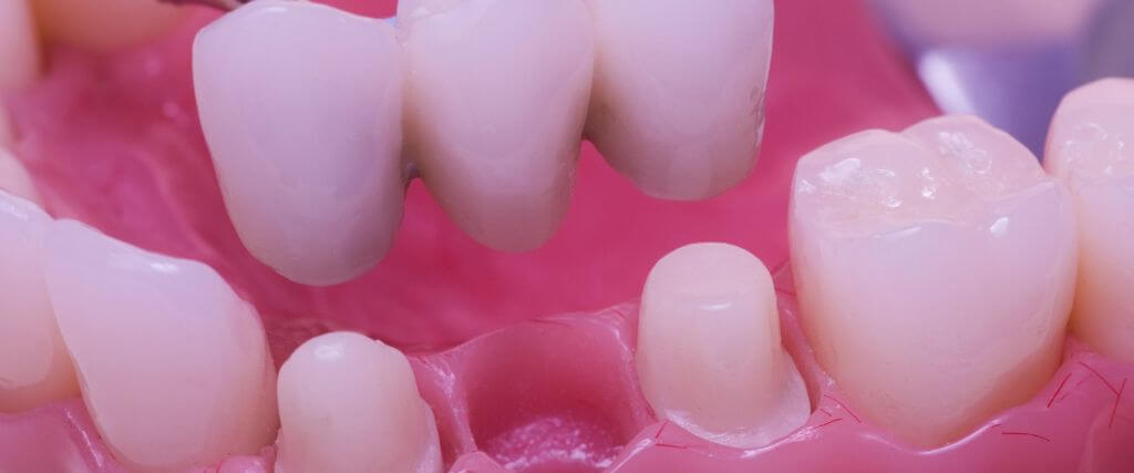 Bridging the Gap: Understanding Dental Bridges in Restorative Dentistry