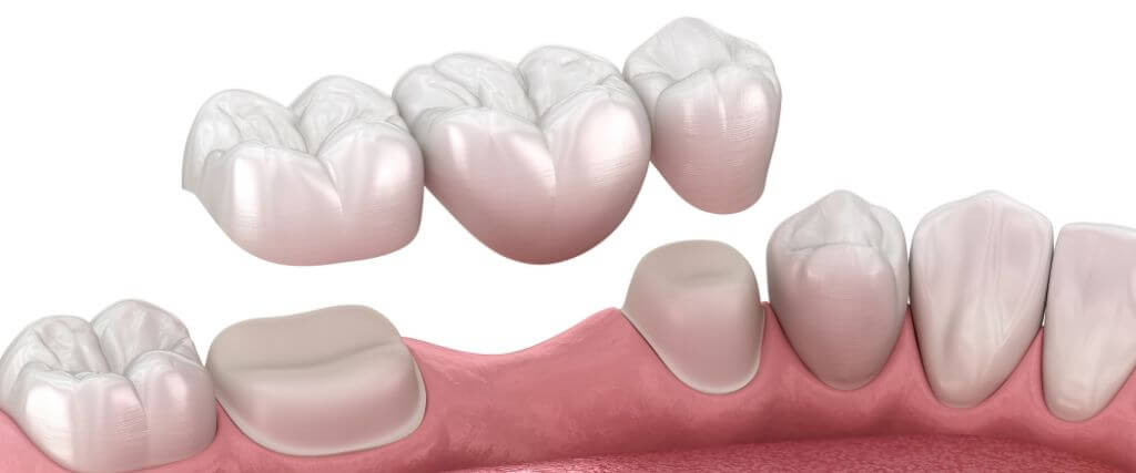 Dental Bridge Materials: Exploring Options for Aesthetic and Functional Results